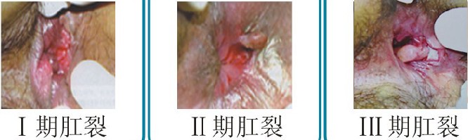肛裂.jpg